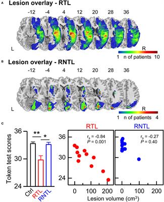 Brain hemispheres with right temporal lobe damage swap dominance in early auditory processing of lexical tones